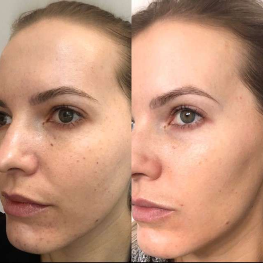 Anua PDRN 100 Hyaluronic Acid Hydrating Capsule Mist | Deep Moisture + Youthful Glow, Plumping & Glass Skin Mist
