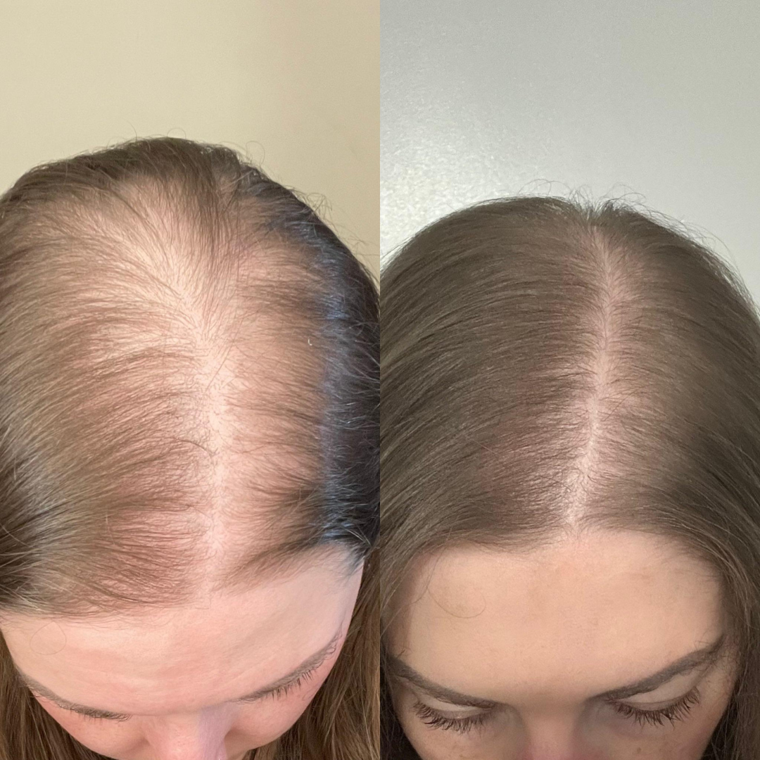 Hair Pantry ProGain+ Hair Fall Serum + Frizz Tamer Serum Deal – Stronger Roots, Smoother Hair, Visible Results –  Reduces Hair Fall, Boosts Growth, Tames Frizz