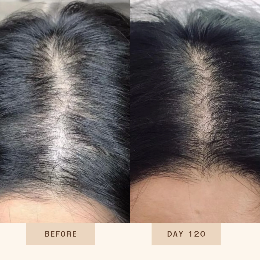 Proskire Anti-Grey Hair Serum – Prevents & Reverses Grey Hair, Reduces White Hair, Darkens & Revitalizes Hair Color – Controls Hair Fall