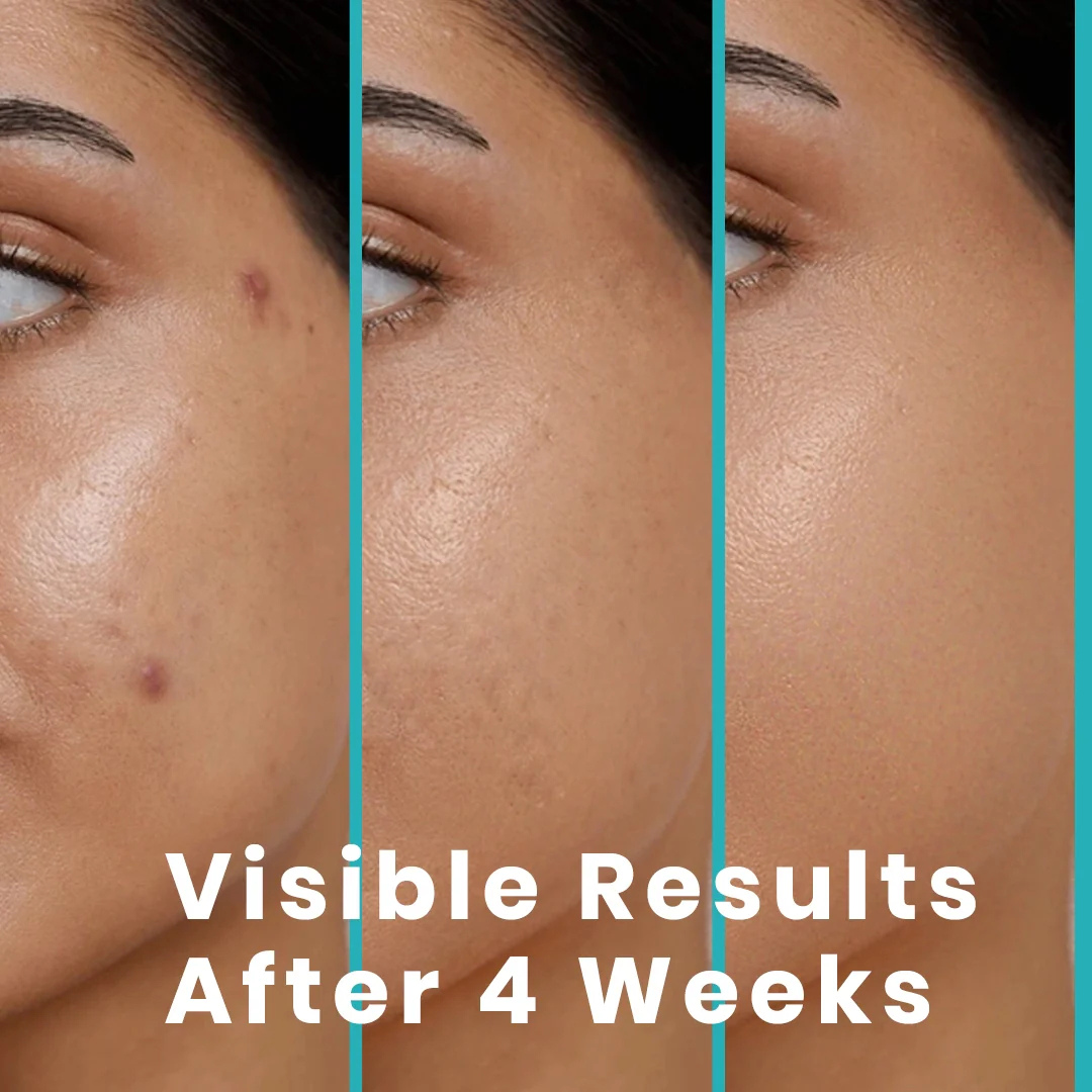 Axis-y Pore Clarifying & Acne treatment Mask | Gently clean pores & remove ance | bright & clean skin