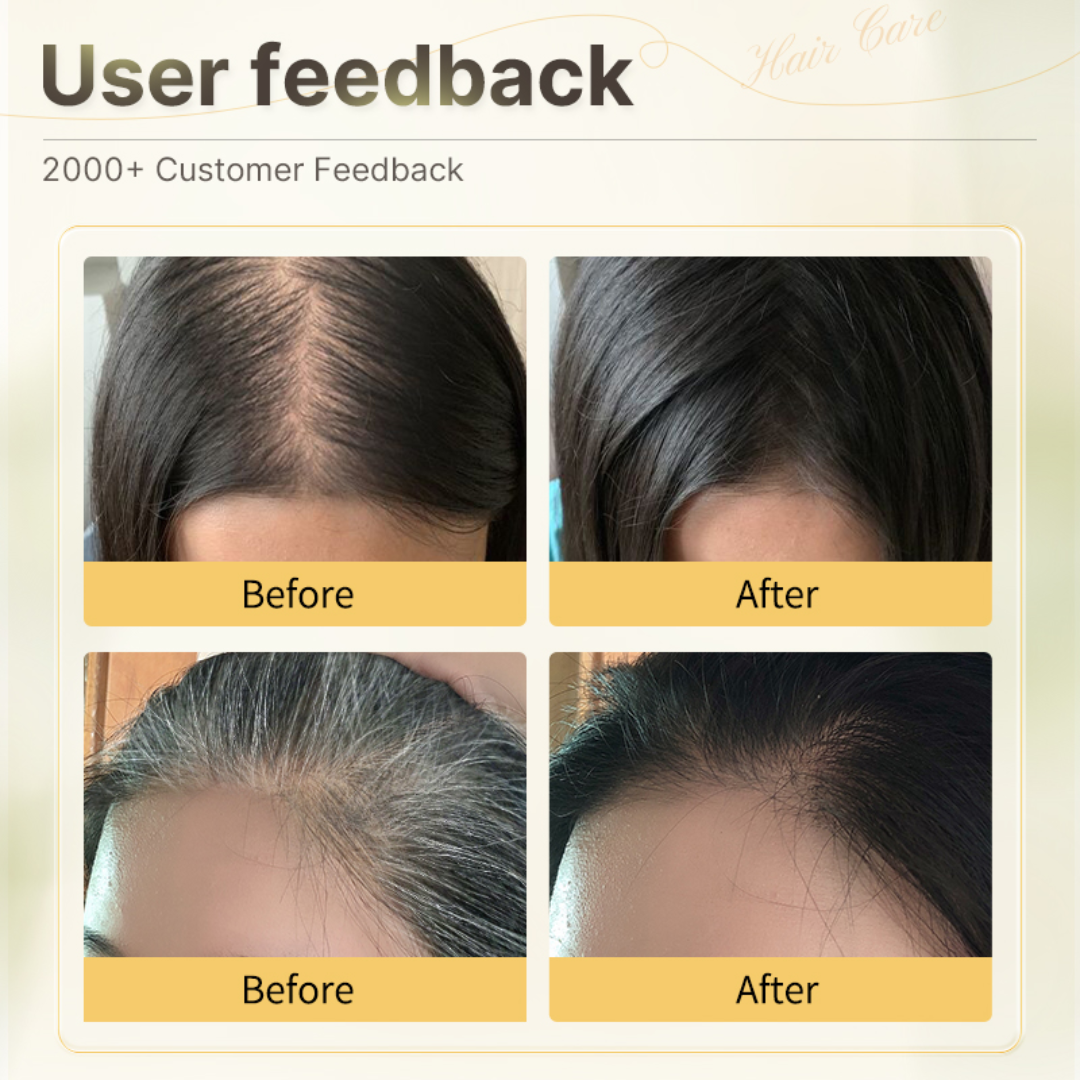 Proskire Anti-Grey Hair Serum – Prevents & Reverses Grey Hair, Reduces White Hair, Darkens & Revitalizes Hair Color – Controls Hair Fall