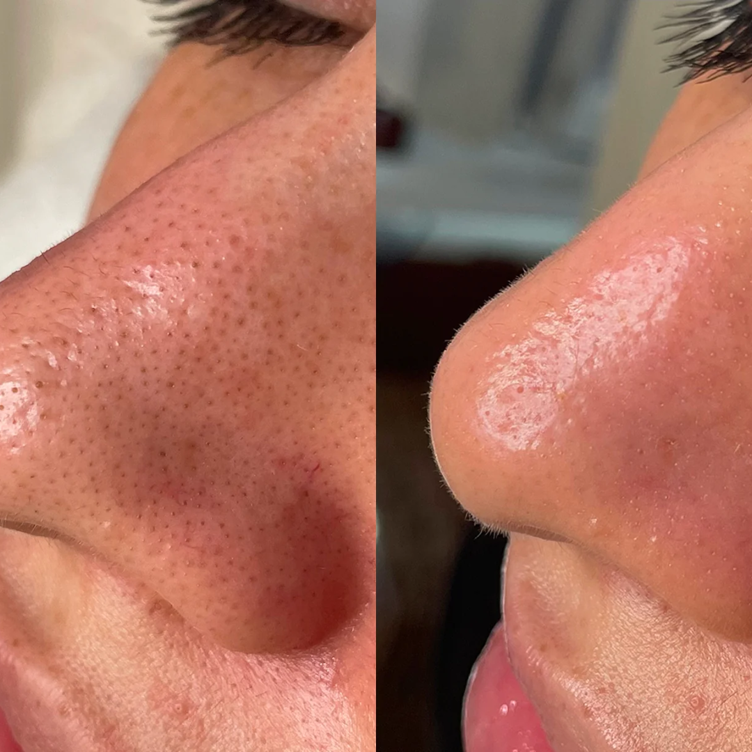 KINUI Calm-7 Soothing Serum | 7 Skin-Perfecting Ingredients with 3 Types of CICA, PDRN, Niacinamide, Panthenol & Tea Tree | Pore Control, Oil Balance & Pigmentation Care