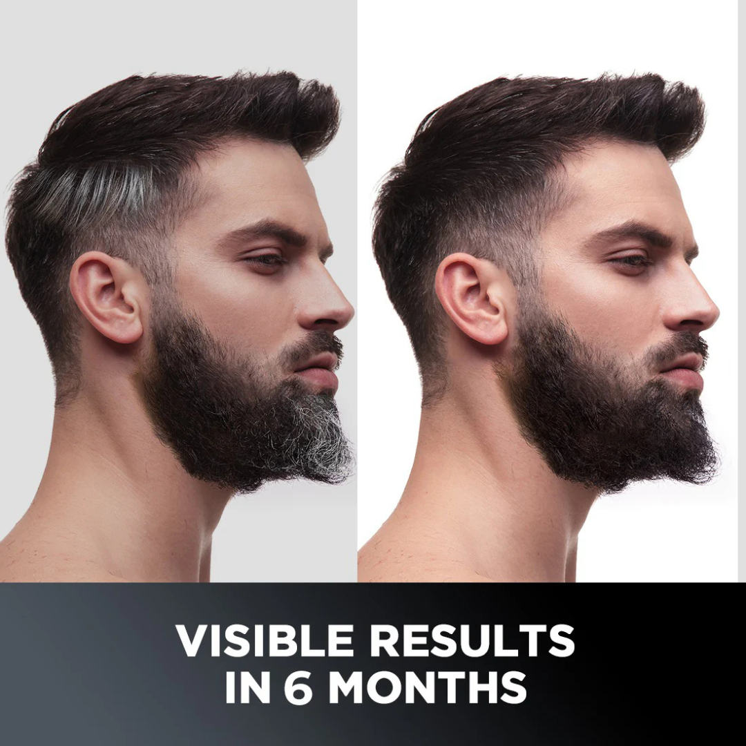Proskire Anti-Grey Hair Serum – Prevents & Reverses Grey Hair, Reduces White Hair, Darkens & Revitalizes Hair Color – Controls Hair Fall