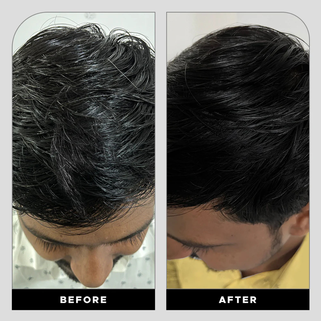 Proskire Anti-Grey Hair Serum – Prevents & Reverses Grey Hair, Reduces White Hair, Darkens & Revitalizes Hair Color – Controls Hair Fall
