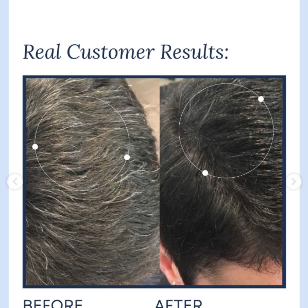 Proskire Anti-Grey Hair Serum – Prevents & Reverses Grey Hair, Reduces White Hair, Darkens & Revitalizes Hair Color – Controls Hair Fall