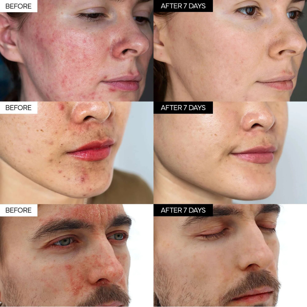 Ivoskin Intensive Cica Repair Cream | 85% Naturally Derived with Madecassoside, Ceramides & Hyaluronic Acid | Calms Redness, Clears Acne & Repairs Skin Barrier